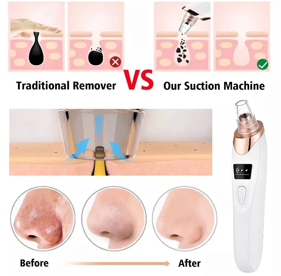 5in1 Blackhead Remover Machine Rechargeable | Face Vacuum Derma Suction