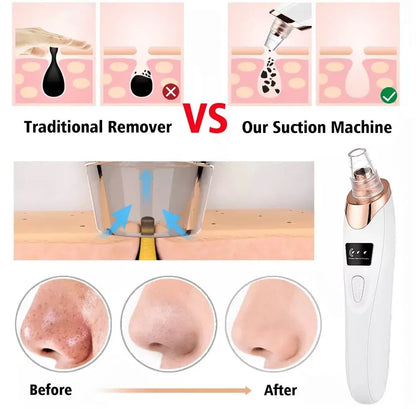 5in1 Blackhead Remover Machine Rechargeable | Face Vacuum Derma Suction